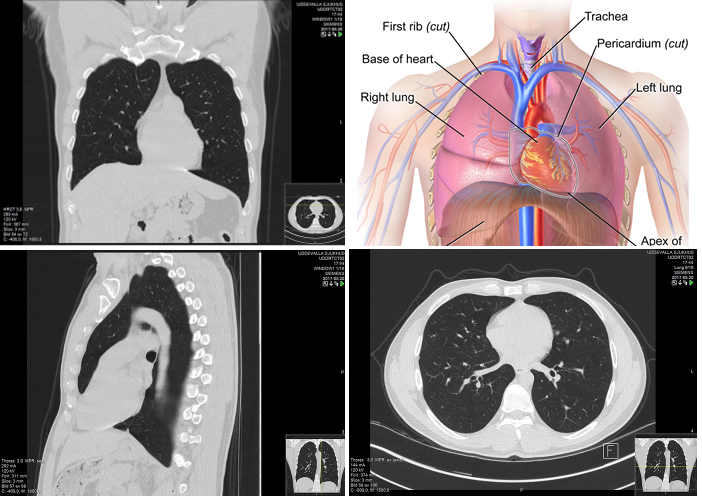 Automatic Interpretation of Chest CT Scans with Machine Learning – Glass Box